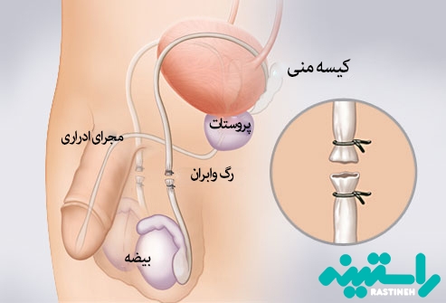  وازکتومی