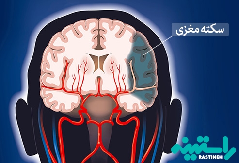 سکته مغزی