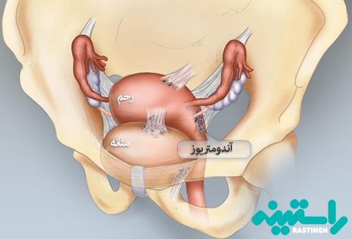 تفاوت فیبروم با اندومتریوز