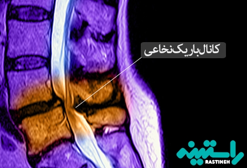 تنگی کانال نخاعی