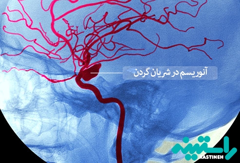 آنوریسم
