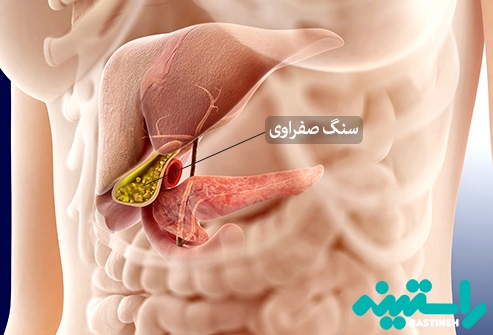 سنگ کیسه صفرا