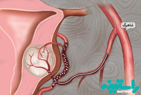 آمبولیزاسیون
