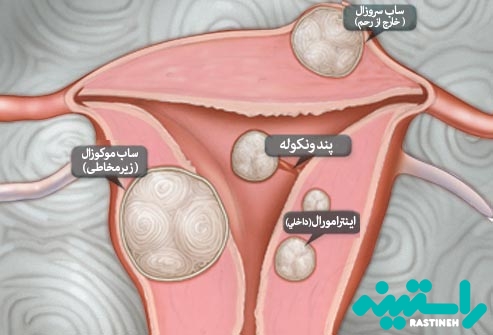انواع فيبروئيد ها