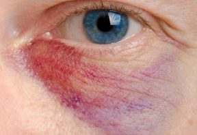 حقایقی درباره هماتوم